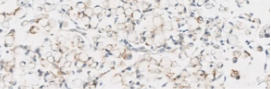 Tissue sample showing weak staining (1+)