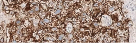 Tissue sample showing moderate staining (2+)