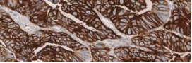 Tissue sample showing strong staining (3+)